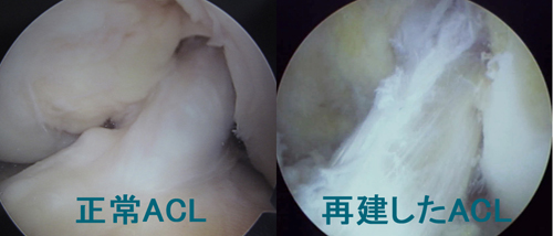 左：正常　右：再建したACL