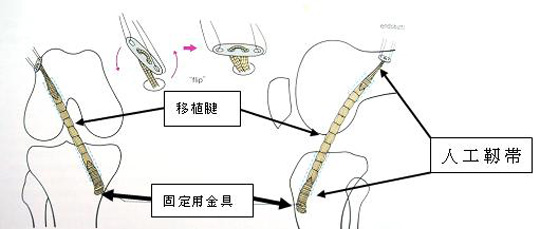 手術模式図