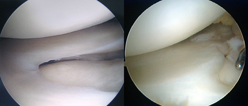 左：正常な半月板　右：円盤状半月板