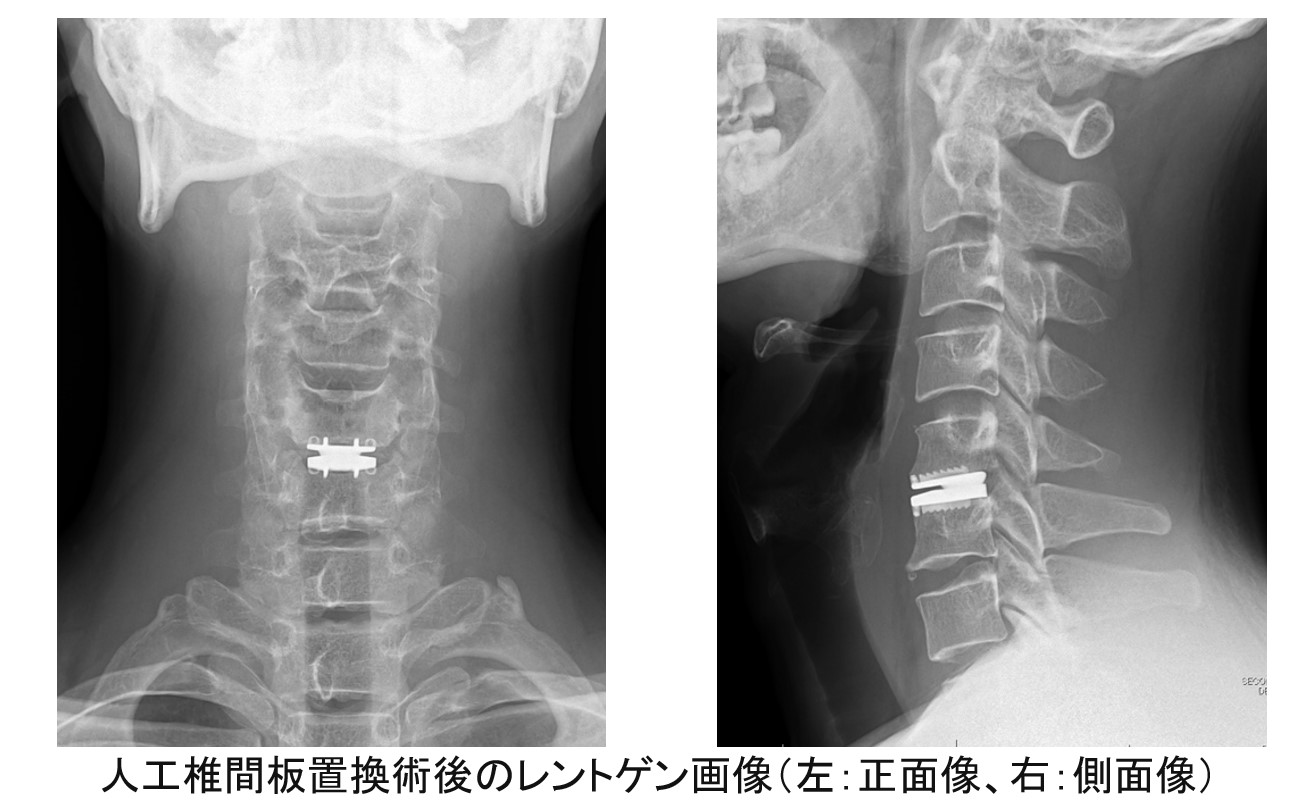 頚椎椎間板ヘルニア・頚椎症性神経根症・頚椎症性筋萎縮症について