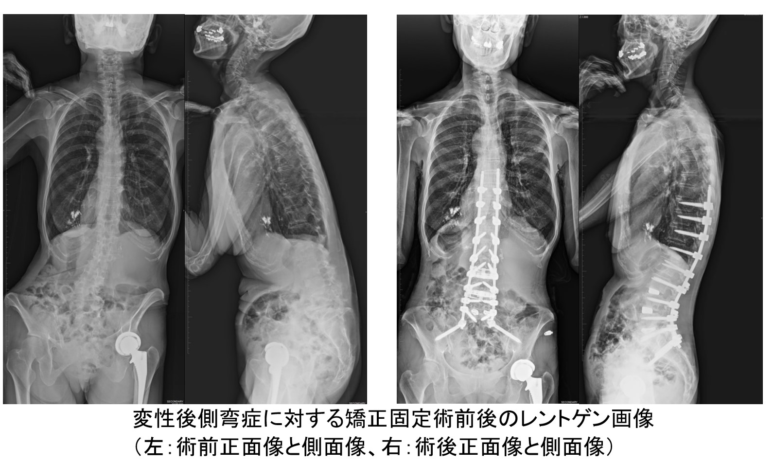 腰椎変性